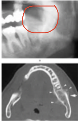 <p>What is this lesion? </p>