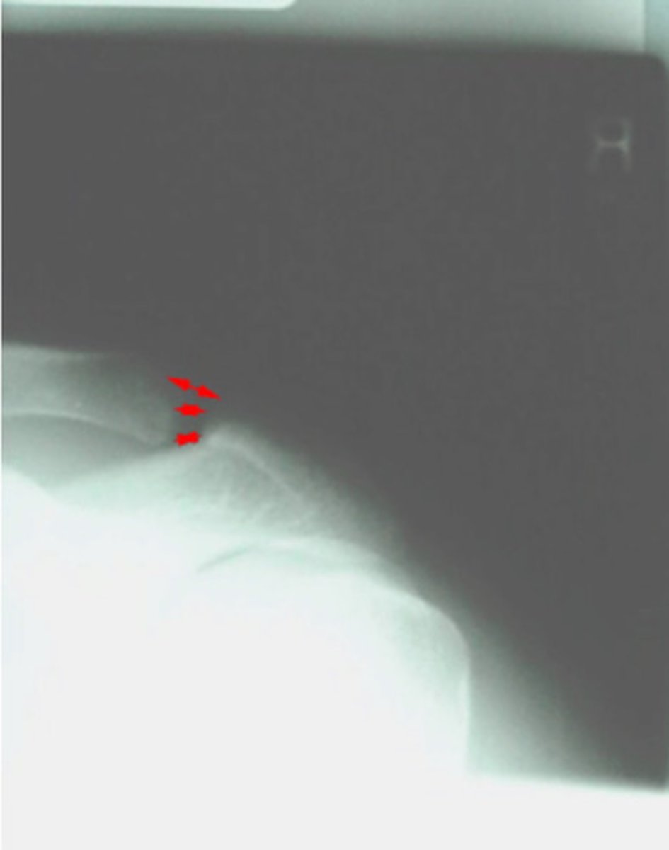 <p>What is the normal measurement for the AC joint space?</p>
