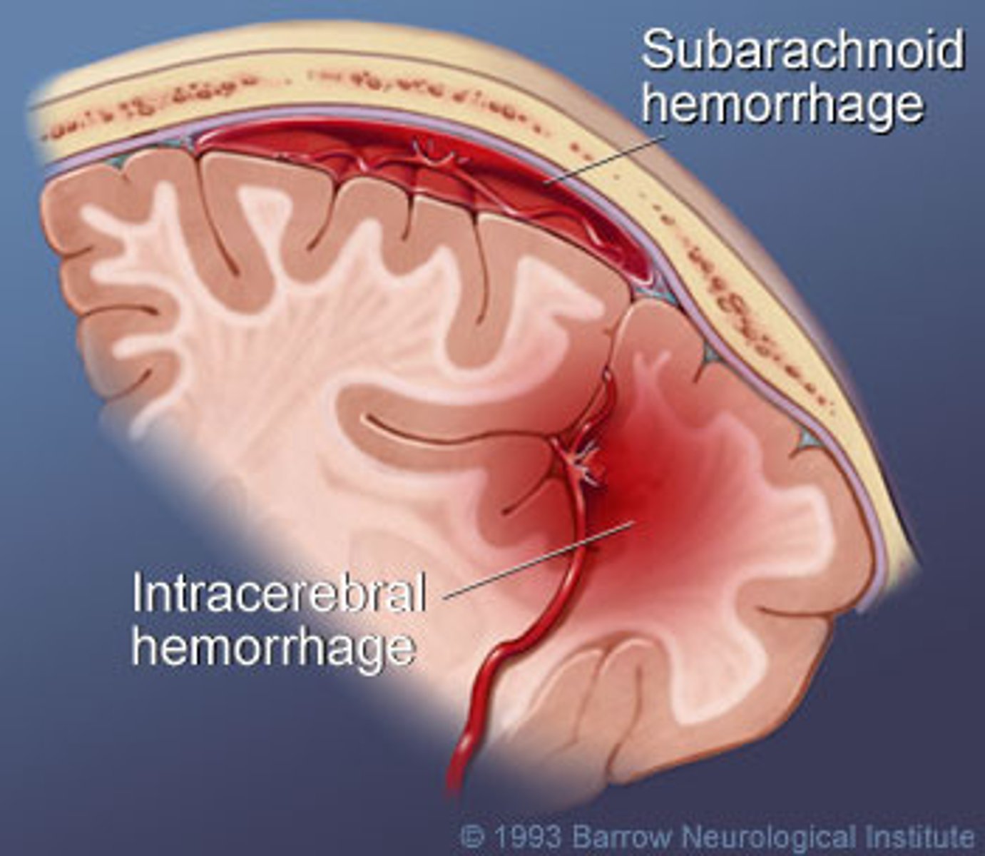 <p>Bleed that occurs within the brain tissue or ventricles itself; common cause of strokes</p>