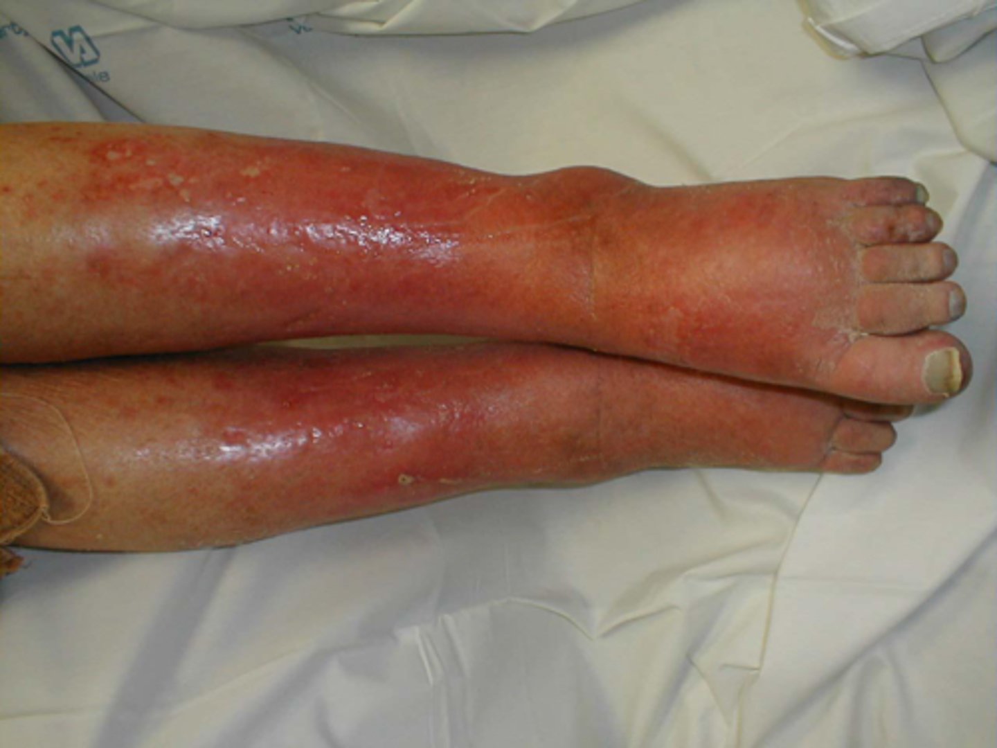 <p>diffuse, acute infection of the skin marked by local heat, redness, pain, and swelling; without sharp demarcated border; is a spreading infection of the epidermis and subcutaneous tissue that usually begins after a break in the skin</p>