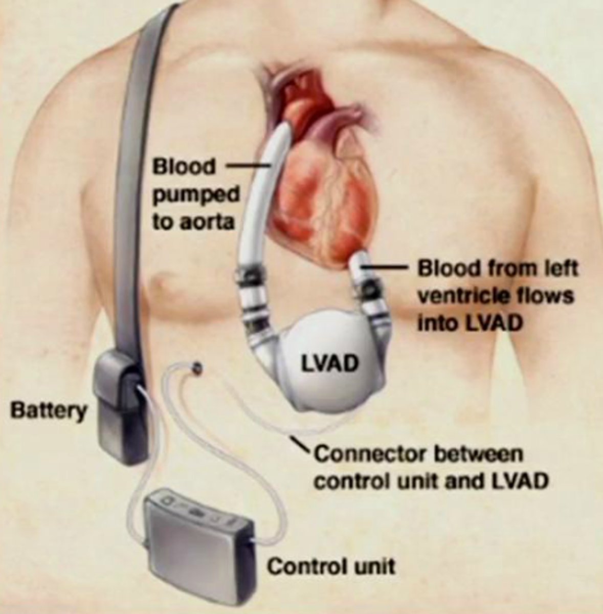 <p>Ventricular Assist Device</p>