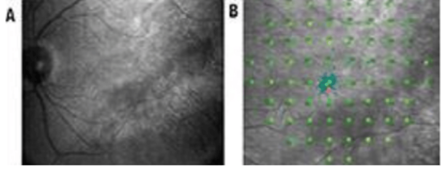 <p>test that uses real time tracking of retinal movements during VF testing to provide spatially registered measurements of retinal sensitivity projected onto a fundus image.</p>