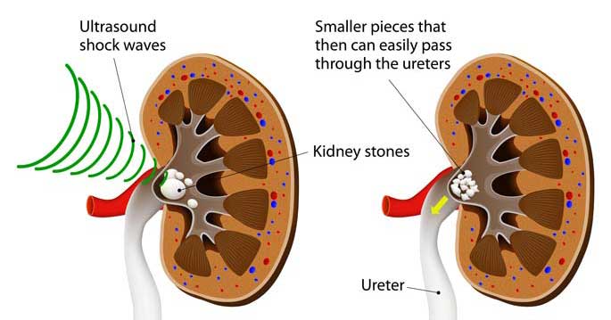 <p>What are the <strong>non-surgical treatments</strong> for gallstones?</p>