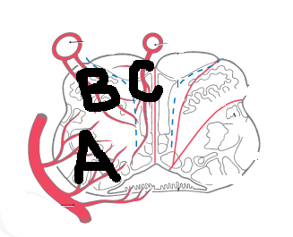 <p>The posterior inferior cerebellar artery supplies which of these 3 medulla zones?</p>