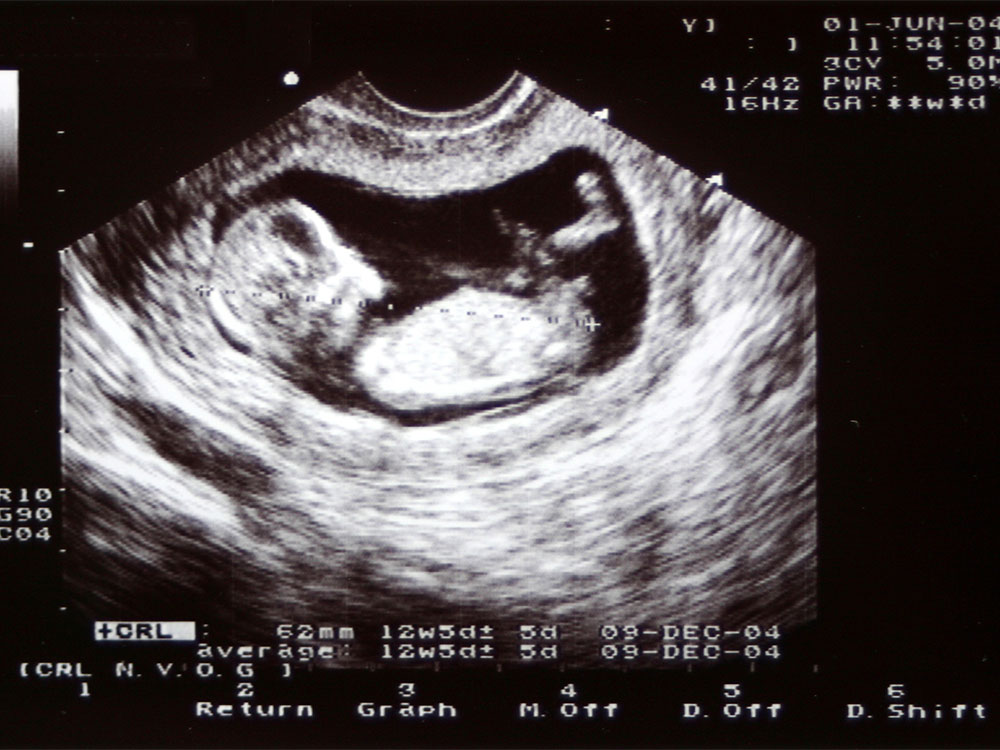 <p>ultrasounds</p>