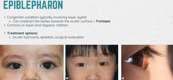 <ul><li><p>Congental condition involving lower eyelid (Trichiasis: misdirects the lashes towards the ocular surface)</p></li><li><p>Common in Asians and Hispanics</p></li><li><p>Treatment: Ocular lubricants, opilation, surgical evaluation</p></li></ul><p></p>