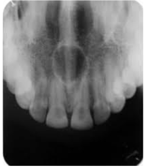 <p>62 year old male patient with complaint of swelling in midline of palate. Provide differential diagnosis and justify</p>