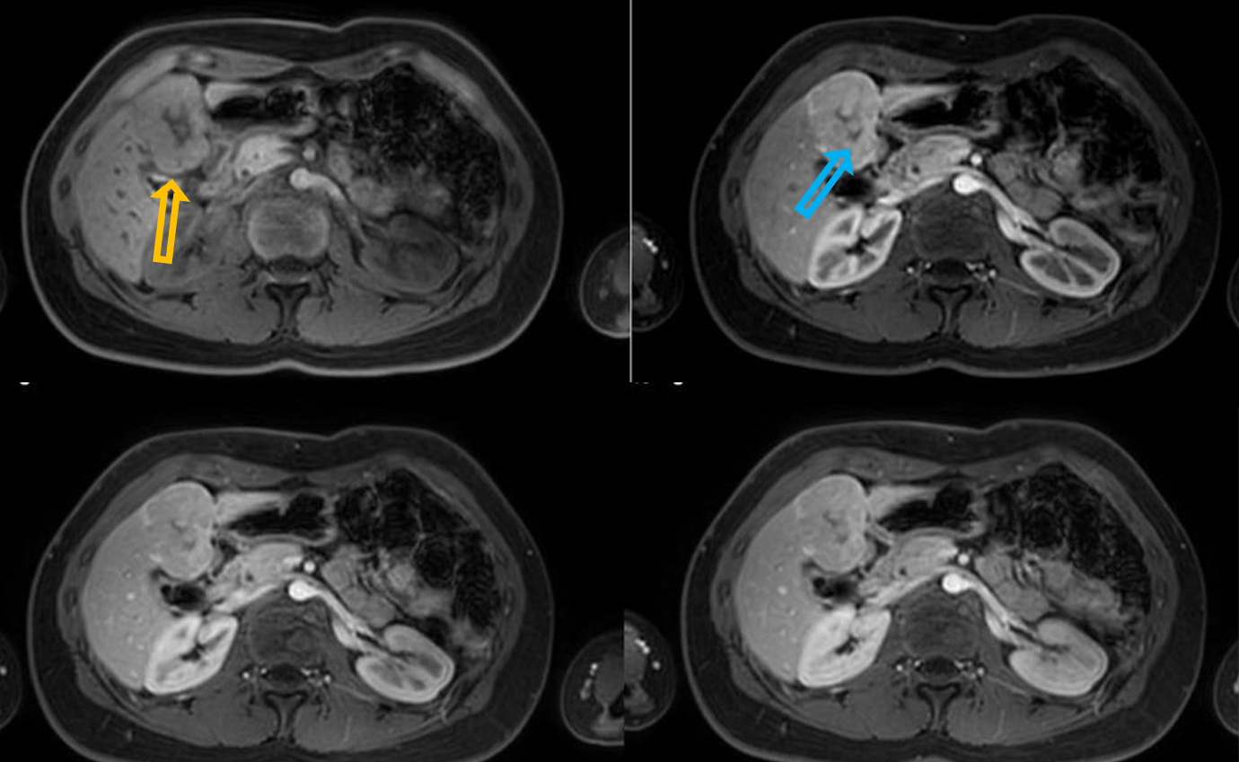 <p>Patient history: liver mass was discovered on a routine abdominal ultrasound, work-up imaging </p><p>Modality: dynamic contrast-enhanced MR (T1 with fatsat) after iv. gadolinium (non-contrast, arterial phase, portal phase, venous phase), axial views </p><p>Region: upper abdomen </p><p>Radiologic sign: large hepatic mass (yellow arrow), intensive arterial enhancement, no „wash-out”, non-enhancing central scar (blue arrow). </p><p>Diagnosis: focal nodular hyperplasia (FNH)</p>