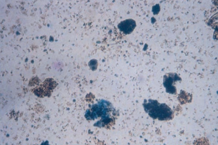 Transitional epithelial cells with hemosiderin granules stained blue