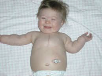 <p><strong>long term feeding tube that enters in the stomach, </strong>used for feeding and medications </p><p>-Percutaneous endoscopic gastrostomy tube (PEG tube) used for feeds and meds. Performed under endoscopy <br>-Mic-Key Button G tube (low profile)</p>