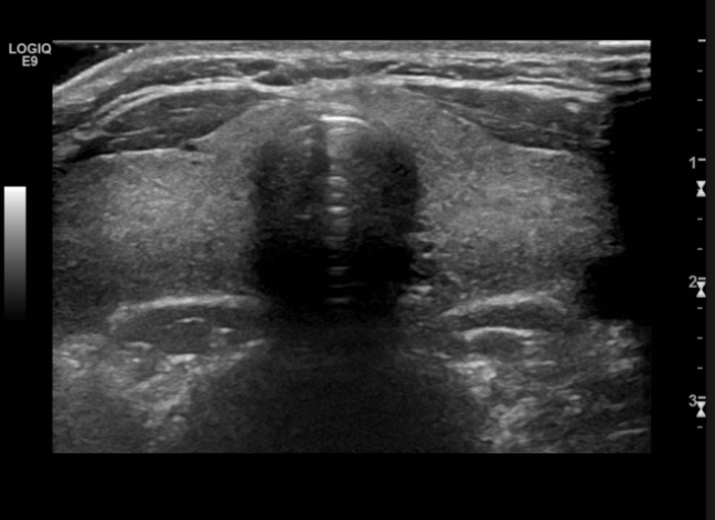 <p>35 y/o women presents to the clinic for odynophagia starting 2 weeks ago. PMHx is positive for the flu. She states that she has been unable to eat due to pain. She reports that she has been intolerant to heat. Vitals are stable with the exception of a 99.0 F temperature and 120 bpm. Physical exam reveals an enlarged thyroid that is tender on palpation. Labs reveal low TSH, elevated T3/T4, elevated ESR and CRP. See u/s. What is your management plan?</p>