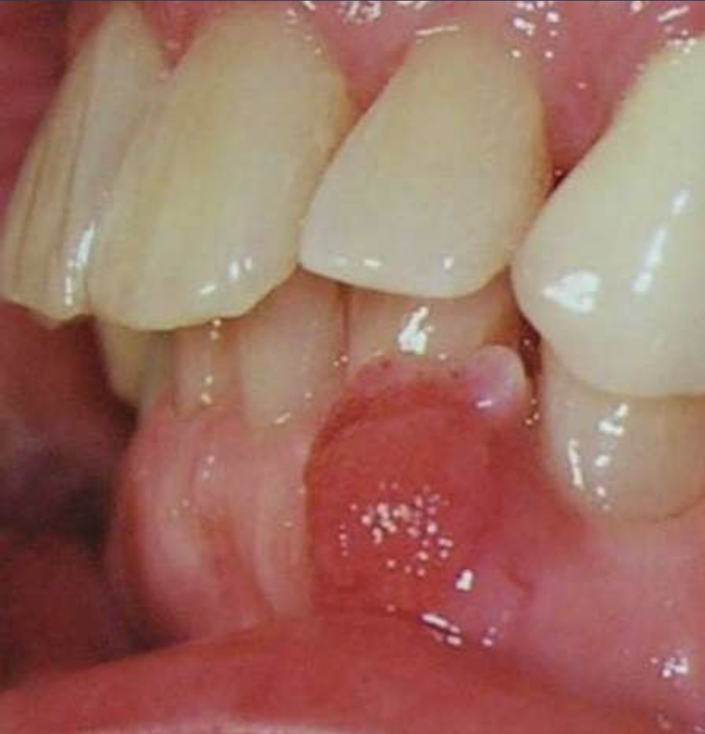 <p>• Painless, non-ulcerated gingival nodule</p><p>• Resembles pyogenic granuloma or fibroma</p><p>• Usually < 1.5cm</p><p>• Superficial alveolar bone may be eroded</p><p></p><p>What benign tumor?</p>