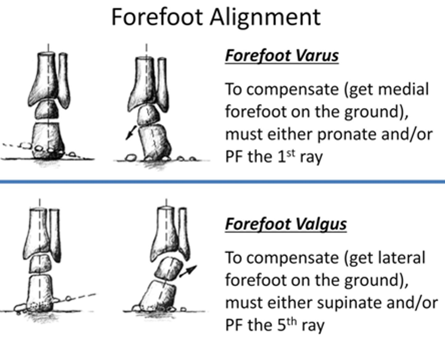 <p>Lateral border is higher than medial border (eversion)</p><p>compensation: RF varus (supination/high arch)</p>