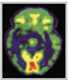 <ul><li><p>Assesses metabolic state</p></li><li><p>Mechanics of PET:</p></li></ul><p>Inject labeled glucose (goes to all cells that use energy)</p><p>Positrons &amp; electrons collide, gamma rays given off</p><p>Analyzed by computer</p><p>Image of glucose (energy) usage</p>