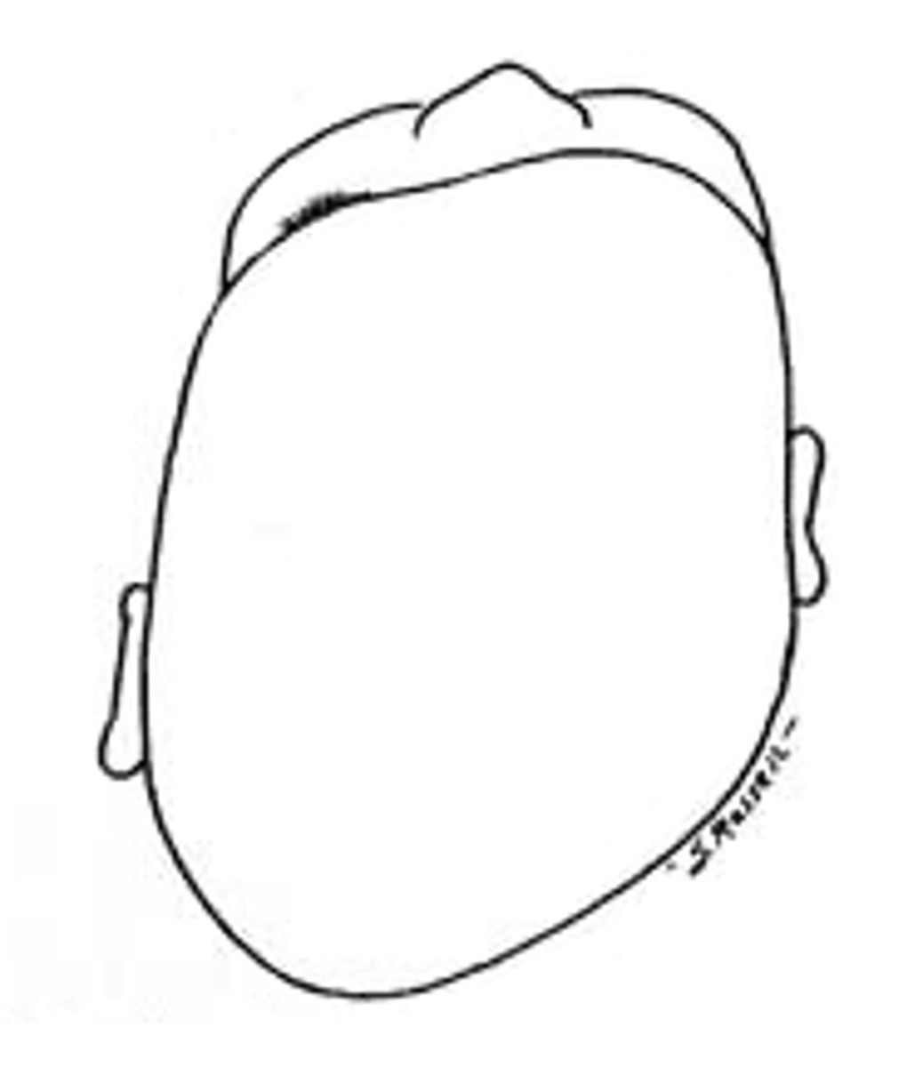 <p>closing of one side of the lambdoid suture resulting in posterior bulging at the contralateral side</p>