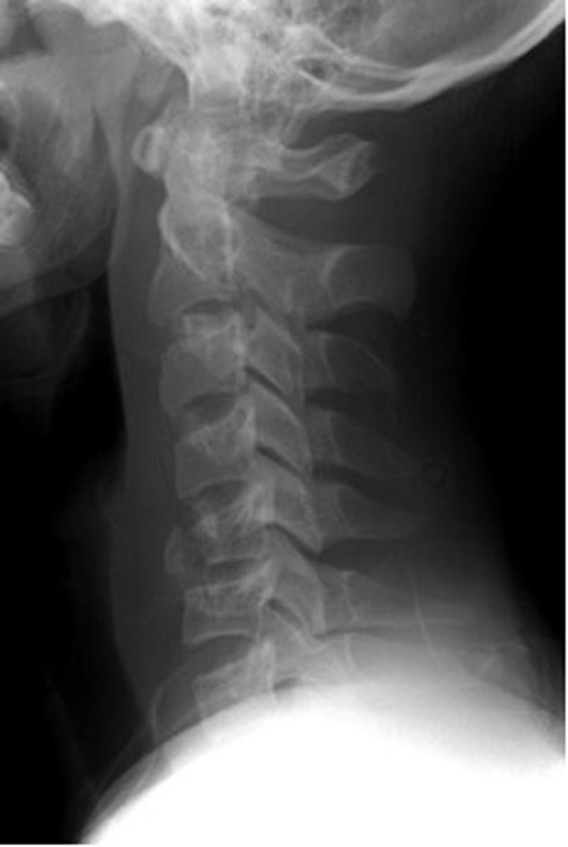 <p>Cervical spine X-ray</p><p>- ↑ risk of ligament laxity &amp; atlantoaxial instability</p><p>- ↑ risk of cervical spinal injury</p>
