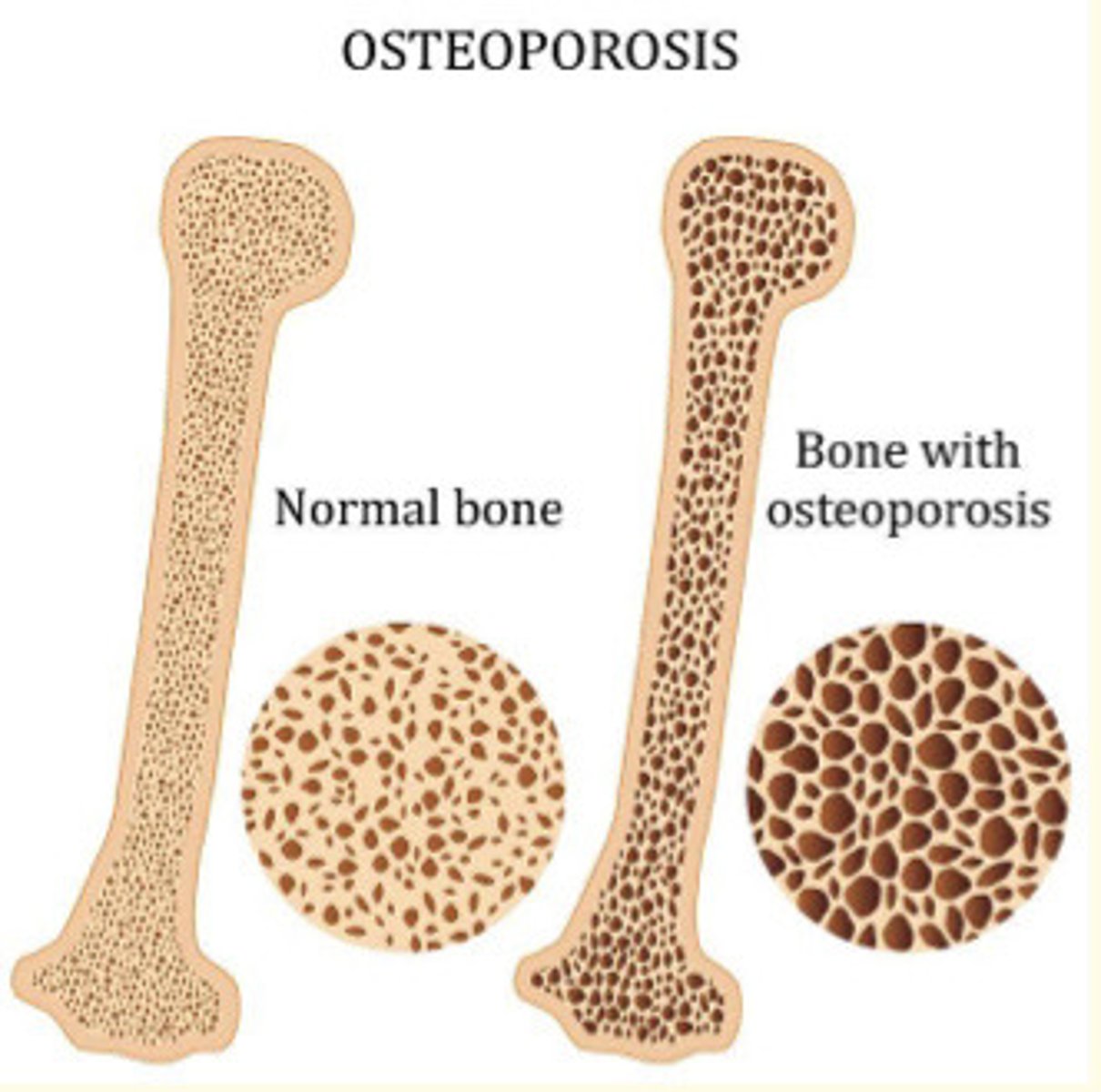 <p>Osteoporosis mainly affects cancellous (spongy) bones</p>