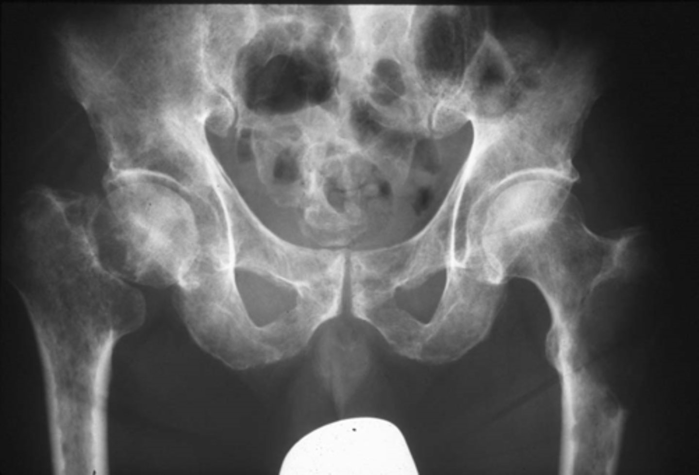 <p>Vignette # 5</p><p>Sex: Male</p><p>Age: 50</p><p>Chief Complaint: Patient presents with hip pain that’s a 6 out of 10 on the pain scale. Objective Findings: Hibbs+, Anvil+</p><p>Diagnostic imaging: X-ray</p><p>2. What is the most likely diagnosis? (Choose 3)</p><p>a. GCT</p><p>b. Blastic lesion</p><p>c. Primary neoplasm</p><p>d. Paget’s disease</p><p>e. Fibrous dysplasia</p><p>f. Hematopoetic disease</p><p>g. Blastic metastasis</p><p>h. Multiple myeloma</p>