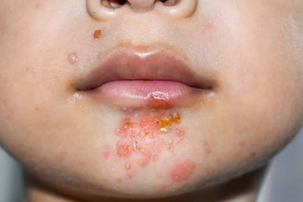 <ul><li><p>Treats <strong><u>non-bullous impetigo</u> </strong></p></li><li><p><mark data-color="purple" style="background-color: purple; color: inherit">In adults or children </mark><strong><mark data-color="purple" style="background-color: purple; color: inherit"><u>over 1 year</u></mark></strong></p></li><li><p><mark data-color="purple" style="background-color: purple; color: inherit">With </mark><strong><mark data-color="purple" style="background-color: purple; color: inherit"><u>3 or FEWER lesions</u></mark></strong></p></li></ul><p></p>