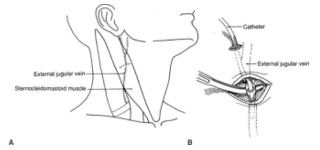 <p><span style="color: rgb(0, 176, 240)">drains retromandibular vein, posterior auricular vein, suprascapular vein, superficial cervical</span></p><p><span style="color: rgb(0, 176, 240)">vein, anterior jugular vein, posterior jugular vein</span></p>