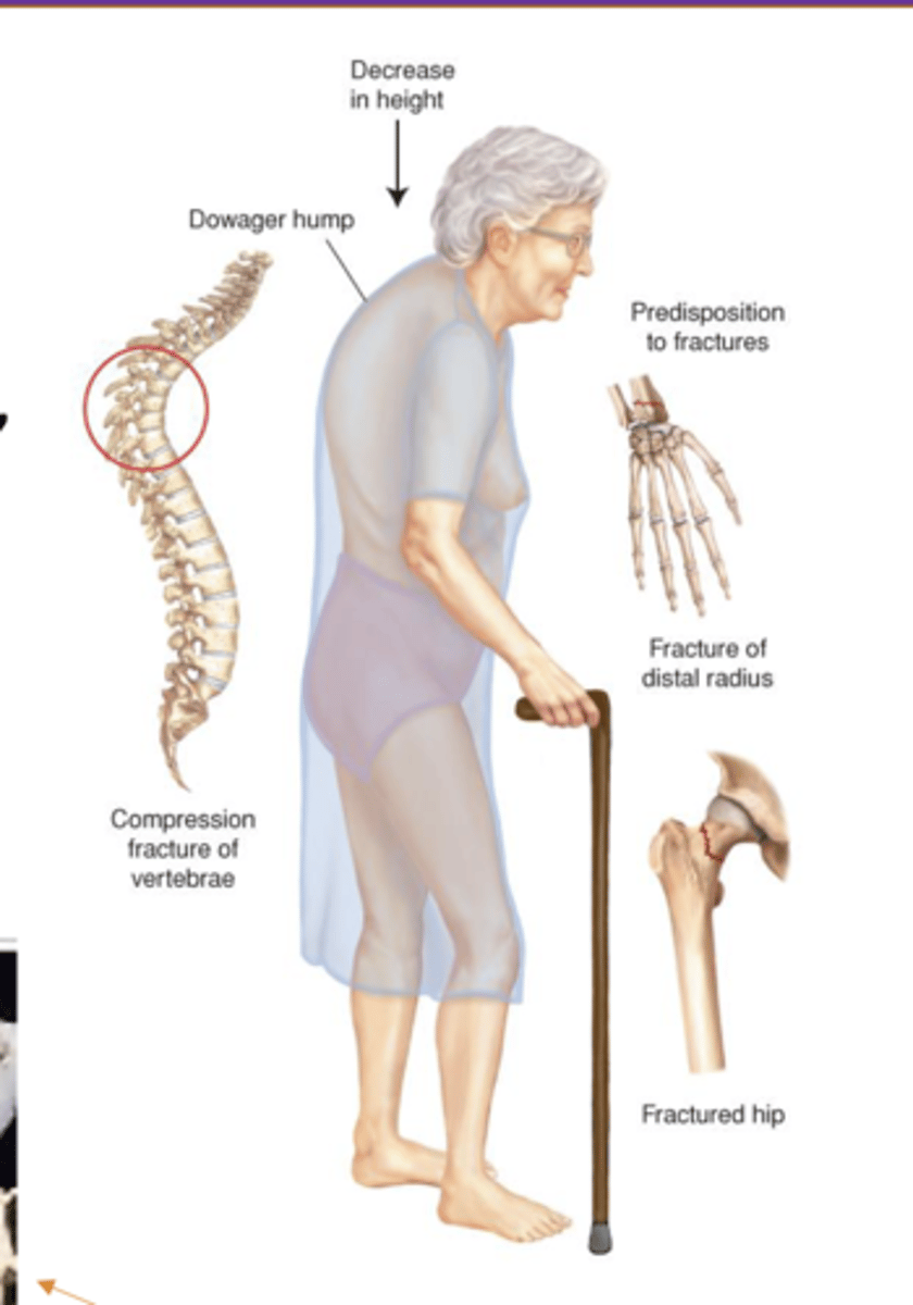 <p>First manifestation: Sudden fractures</p><p>-- Vertebral compression fracture</p><p>-- Fracture of vertebra(e), hip, pelvis, humerus</p><p>Wedging &amp; collapse of vertebrae</p><p>-- Loss of height in the vertebral column</p><p>-- Kyphosis- Dowager hump</p>