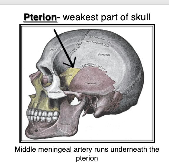 <p>A condition resulting from a rupture of the Pterion → meningeal artery, often due to a fracture at the pterion.</p>