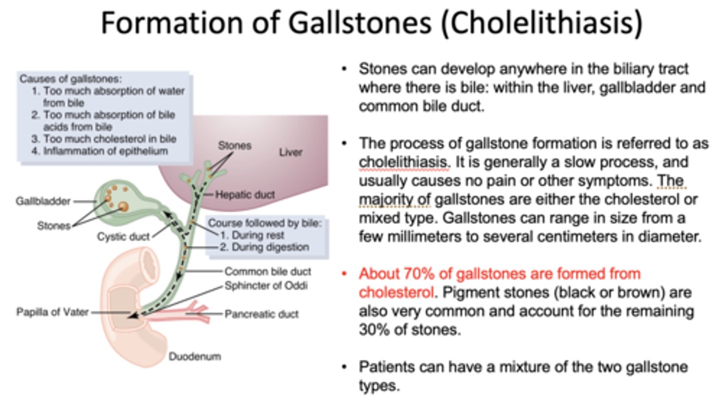 <p>cholelithiasis</p>
