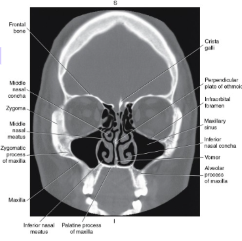 <p><strong>inferior nasal conchae </strong></p>