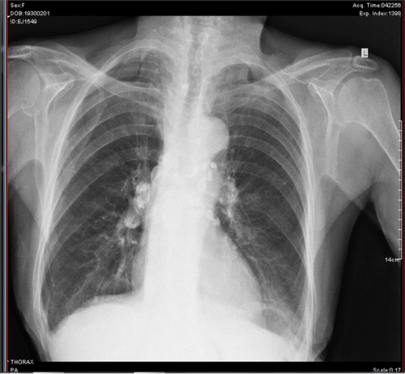 <p>primary lesion, lymphangitis, hilar lymphadenopathy</p>