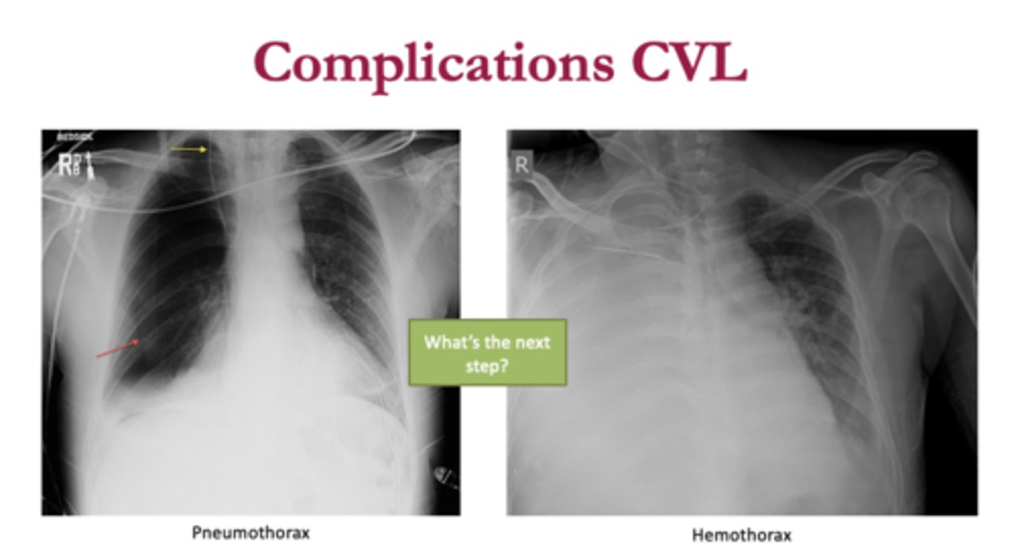 <p>o When parietal pleura is torn, lung recoils as air is sucked into the pleural space; results in pneumothorax</p><p>o If blood accumulates in pleural space, lung collapse due to hemothorax</p>