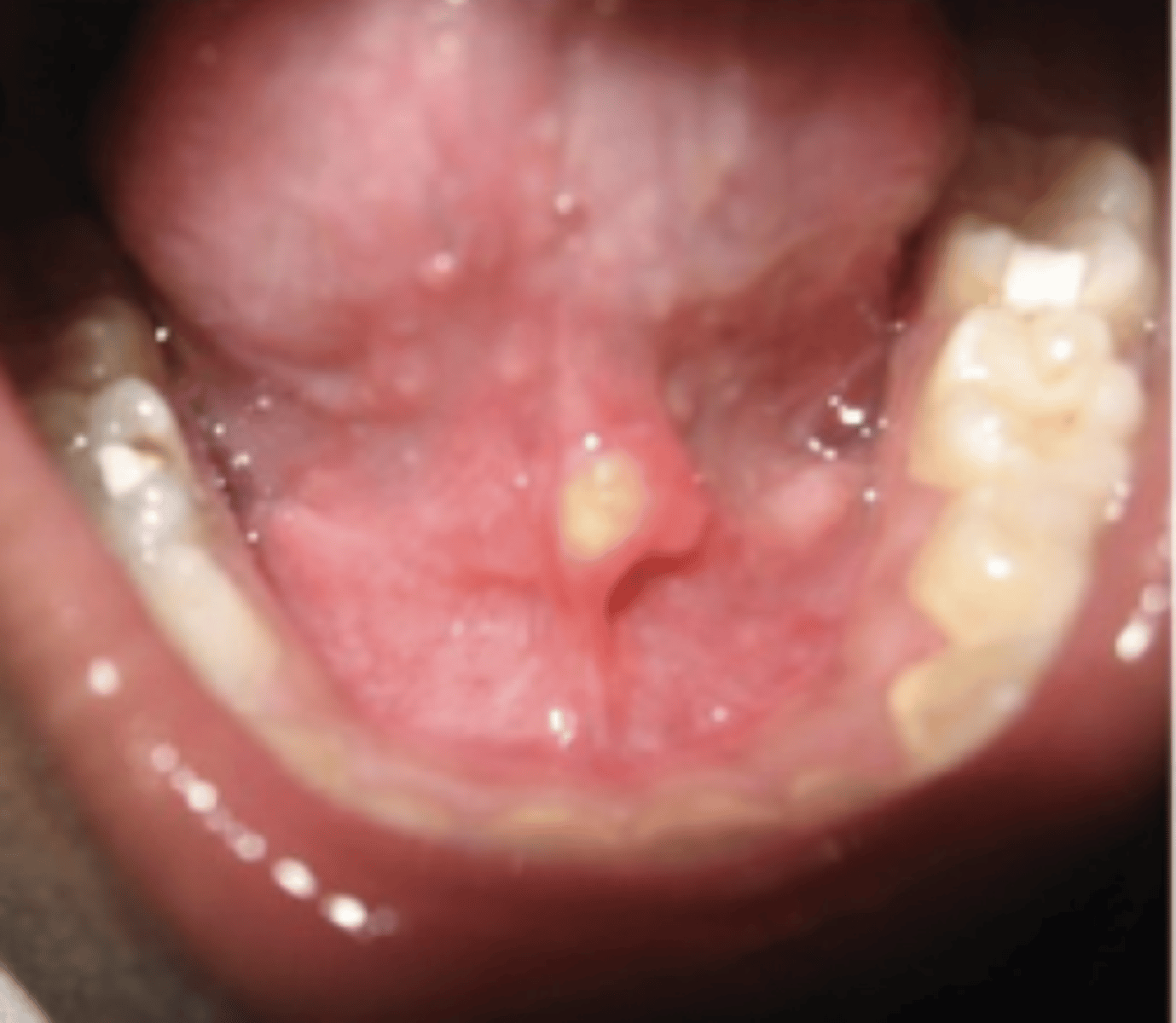 <p>Deposits of calcium salts in the salivary gland/ duct, Decreased salivary flow OR increased viscosity</p>