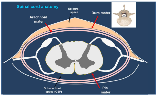 <ul><li><p class="">Drug injected into the <strong>epidural space</strong> at any spinal level</p></li><li><p class="">Blocks <strong>spinal roots</strong></p></li><li><p class="">Produces anaesthesia of the <strong>thorax, abdomen &amp; lower limbs</strong></p></li></ul><p></p>