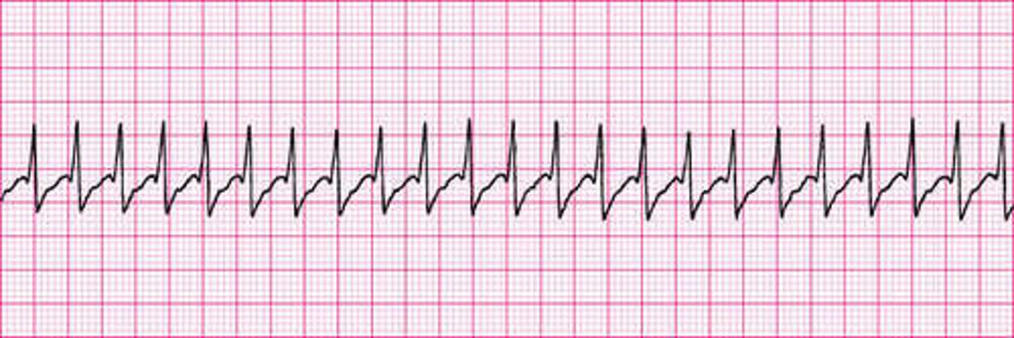 <p>SSSSuper fast heartbeatCauses: Strenuous exercise, heart disease, stimulants, hypoxiaTX: use the vagal maneuver, ice cold stimulant: ice around the neckAdenosine: may cause heartbeat to stop Cardioversion (always remember to sync first)</p>