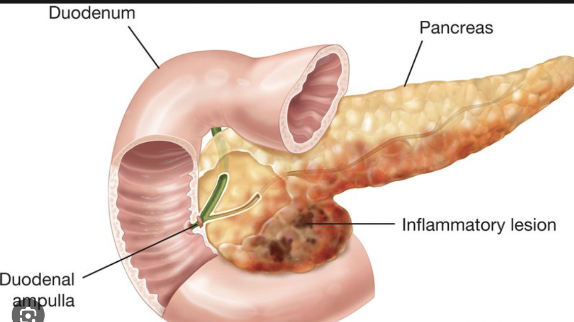 <p>Pancreatitis (pancreat-)</p>