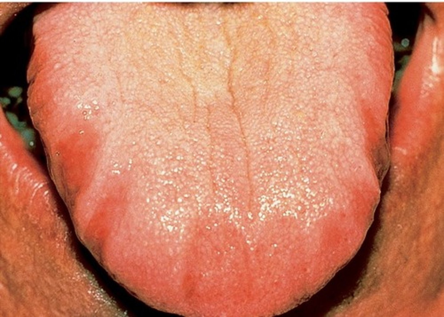 <p>due to how the tongue rests against the teeth, such as when the tongue is larger than the arch</p><p>- can become more prominent with age</p>