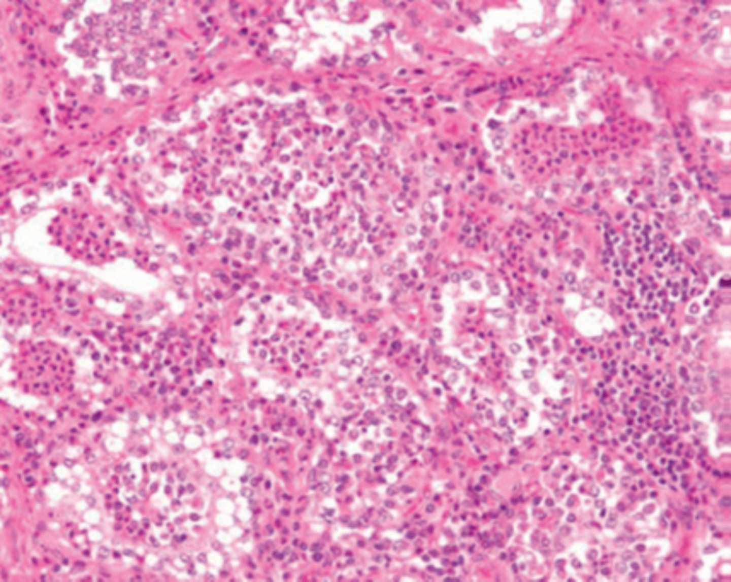 <p>Describe the histopathology of a mammary gland in a cow with bovine mastitis</p>
