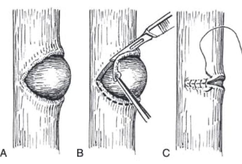 <p>Surgery is indicated due to the risk of obstruction and rupture → diverticulectomy, mucosa inversion preferred&nbsp;</p>
