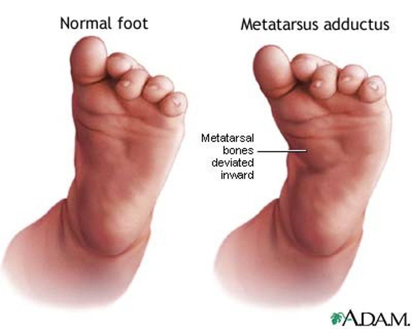 <p>medial deviation of the forefoot</p><p>- commonly seen in infants</p><p>- often a result of intrauterine position</p><p>- must differentiate between flexible vs inflexible on PE</p>