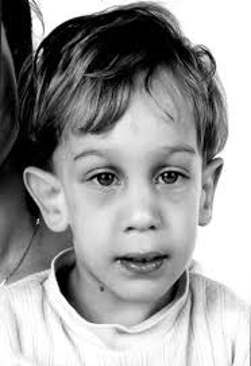 <p>FMR1 gene has lots of repetitions of CGG</p><p>large, long pinna, big jaw, enlarged testes, high forehead.</p><p>ID (leading inherited cause of ID in males) mild-mod in children, more severe in adulthood</p><p>Jargon, perseveration, echolalia, inappropriate language, lack of gestures and other nonverbals, voice and artic disorders.</p><p>Autistic-like social deficiencies</p>