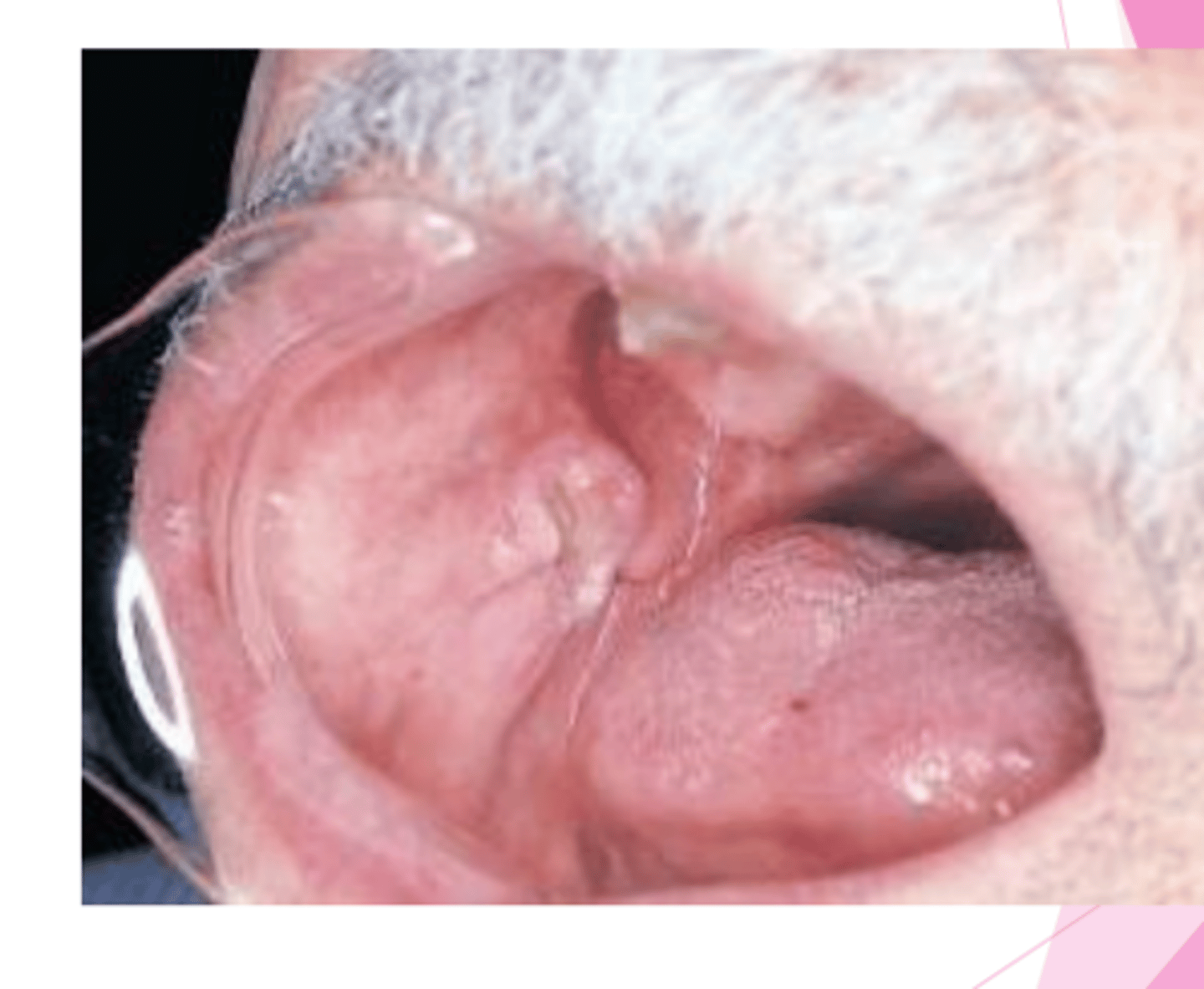 <p>long-standing traumatic ulcer</p><p>• raised, firm border</p>