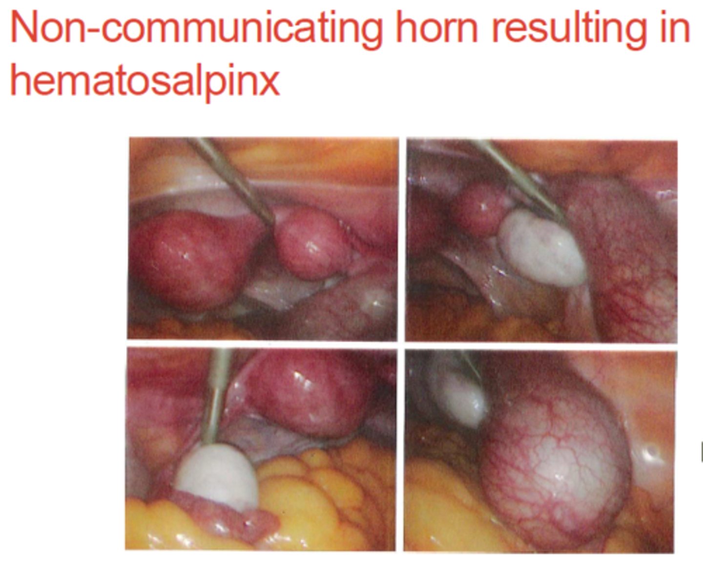 <p>blood in the fallopian tube</p>