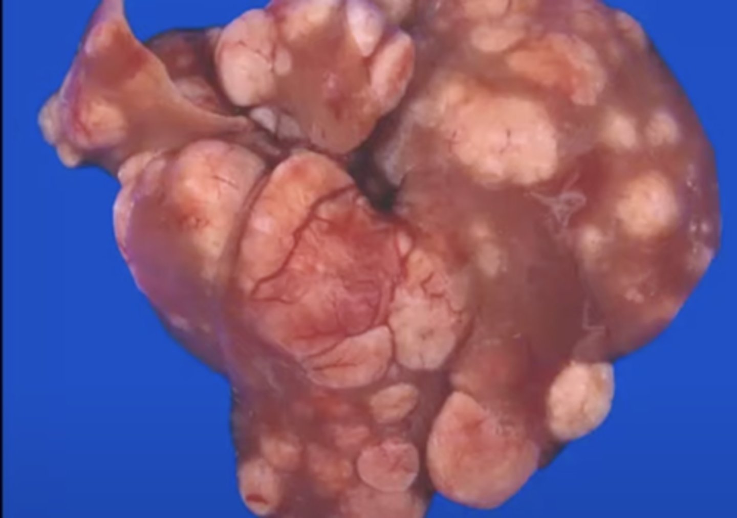 <p>What has caused this gross appearance of this mouse liver?</p>