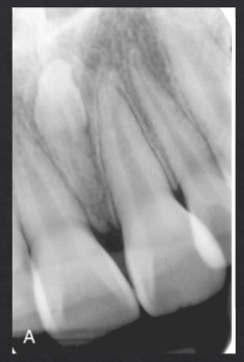 <p>Supernumerary tooth between maxillary central incisors</p>