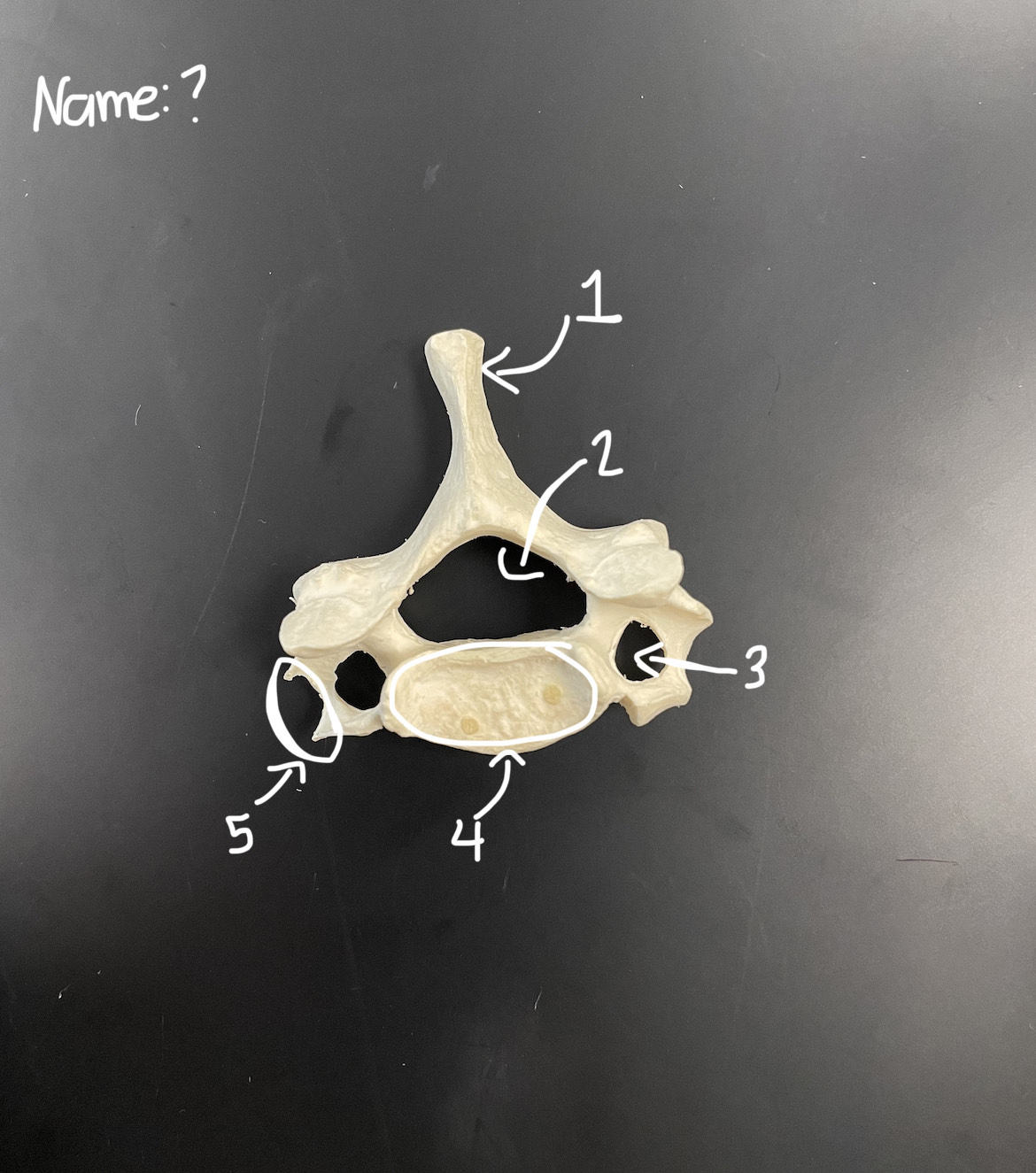 <p>vertebral foramen</p>