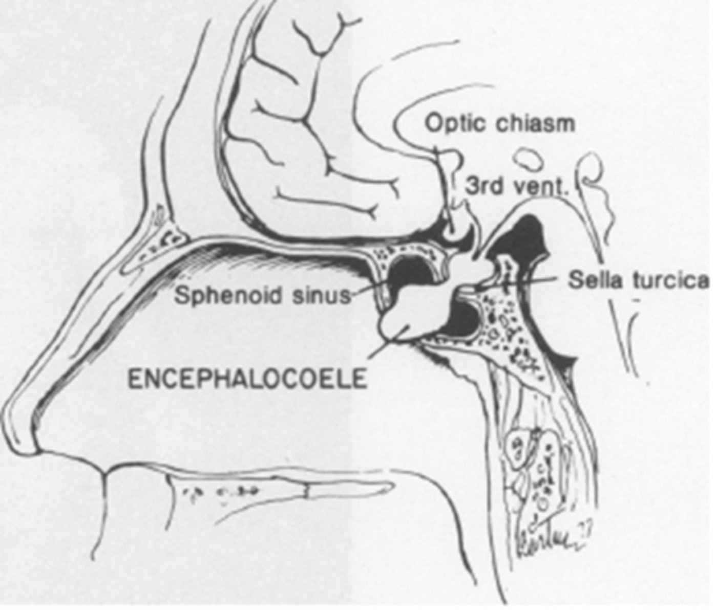 <p>refer to pediatrician to assess:</p><p>GH levels</p><p>thyroid function</p><p>endocrine function</p><p>CT/MRI to look for basal encephalocoele = abnormal communication of bone that allows brain tissue to herniate into orbit, nasal pharynx, etc</p>