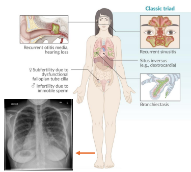 <p><strong>Kartagener Syndrome (</strong>Primary Ciliary Dyskinesia<strong>)</strong></p>