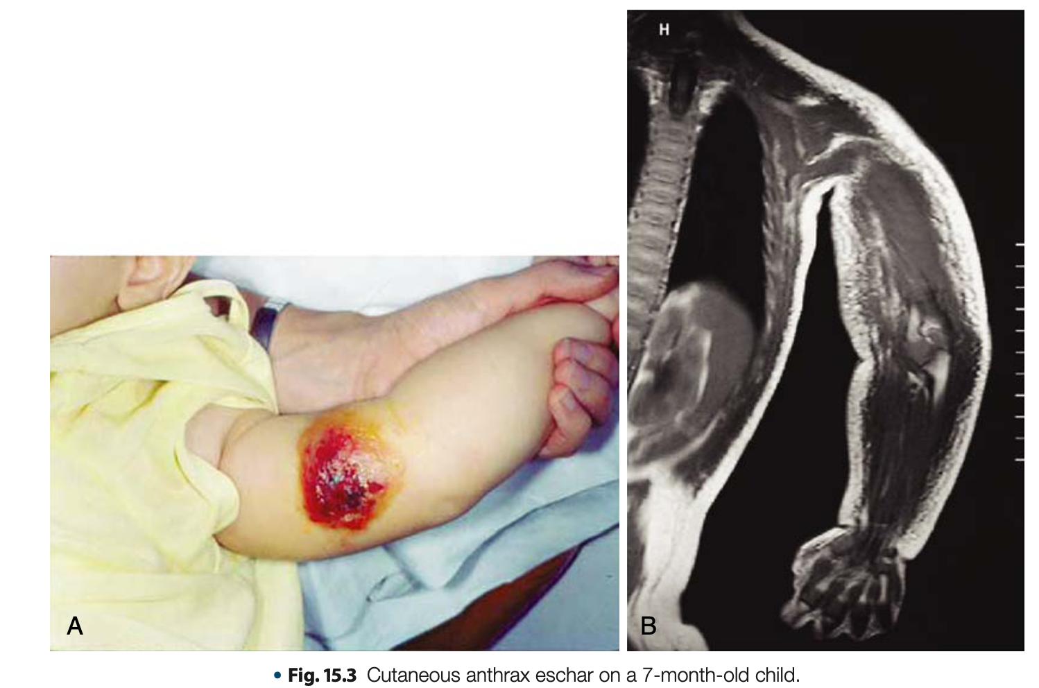 <p>Cutaneous Anthrax</p>