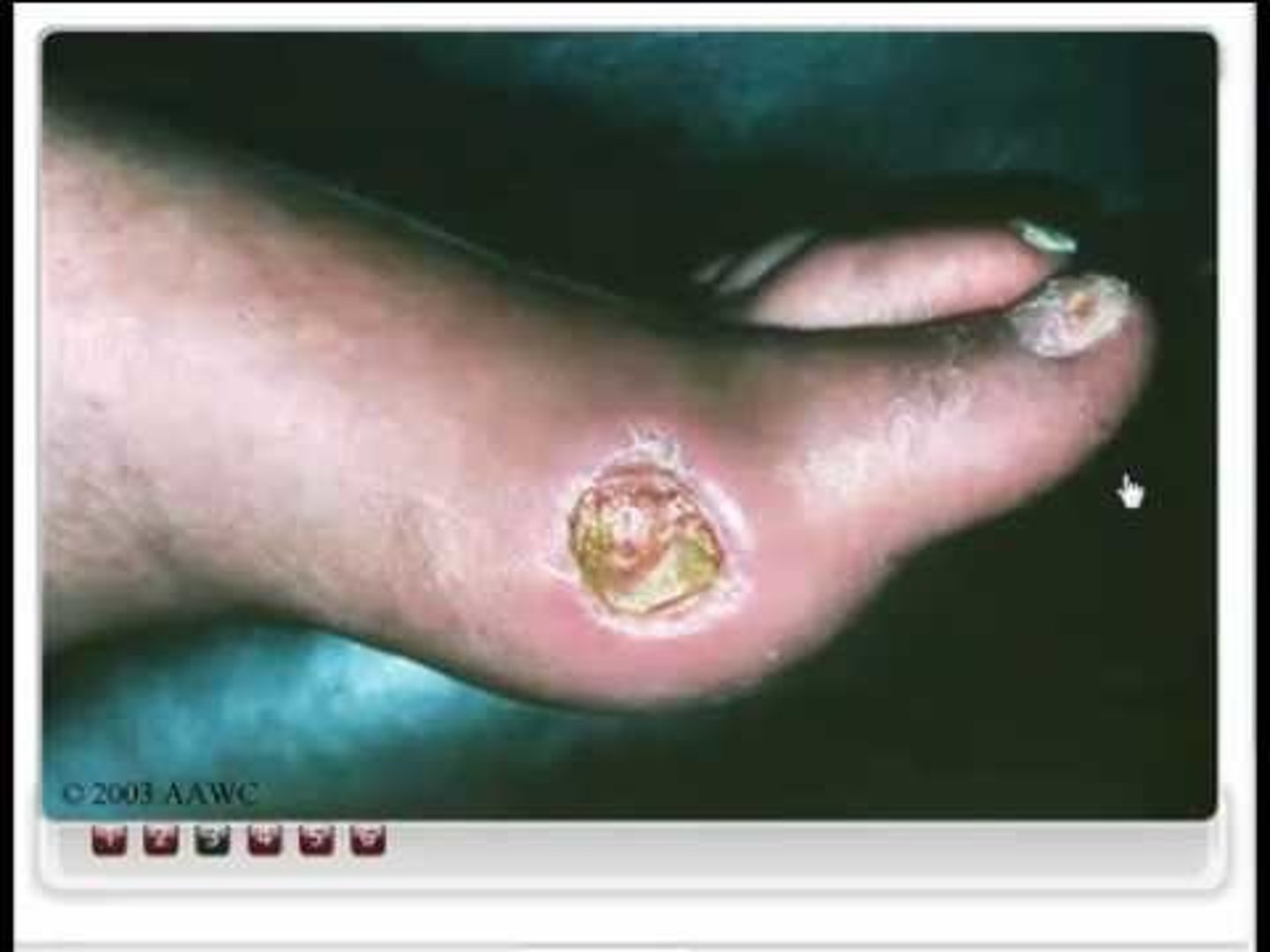 <p>Ulcers occurring due to damage to the arteries caused by lack of blood flow to tissues.</p>