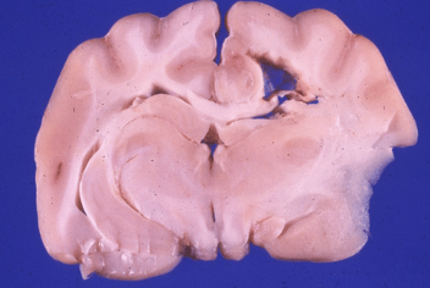 <p>What type of necrosis is being shown in this photo?</p>