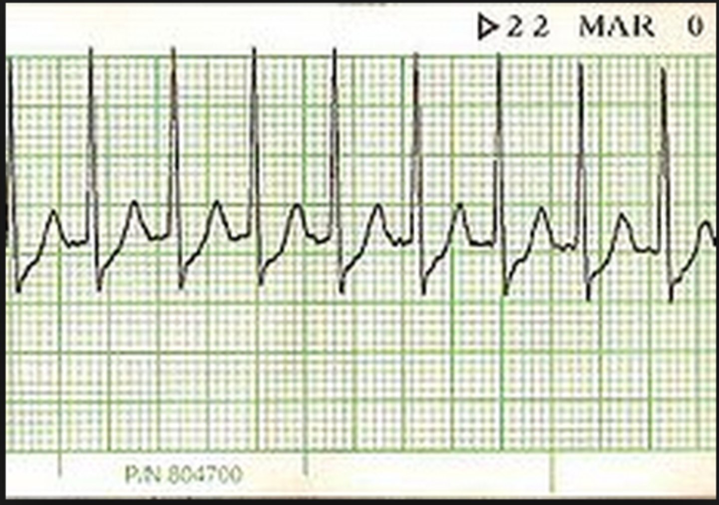 <p>-P waves buried within QRS </p><p>-pseudo R' seen in V1</p><p>-narrow QRS</p><p>-1:1 P:QRS</p><p>-Regular rhythm </p><p>-150-250bmp</p><p>-Origin: AV node reentry loop </p><p>-common arrhythmia, usually initiated by premature supraventricular beat, sudden onset/ termination </p>